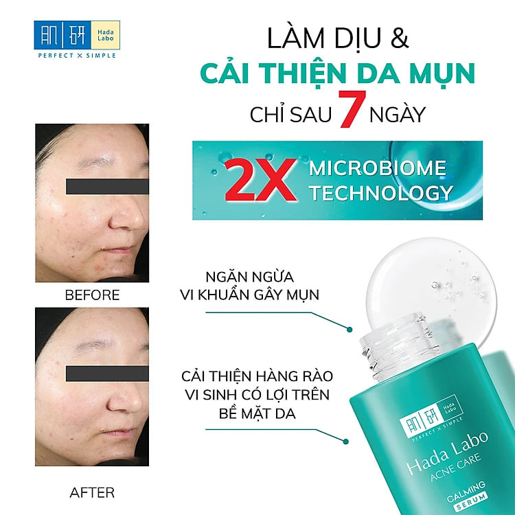 Serum dưỡng ẩm cho da mụn, nhạy cảm Hada Labo Acne Care Calming Serum 30ml